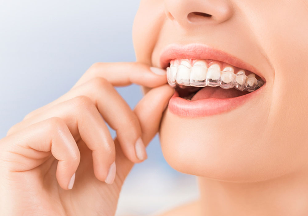 Invisalign in saskatoon