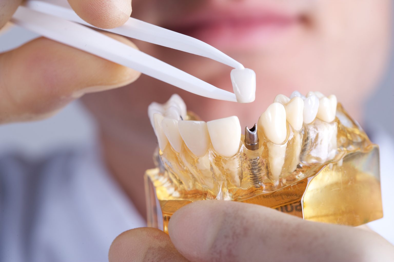 dental implants in saskatoon