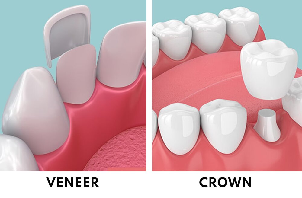 difference between dental crowns and porcelain veneers