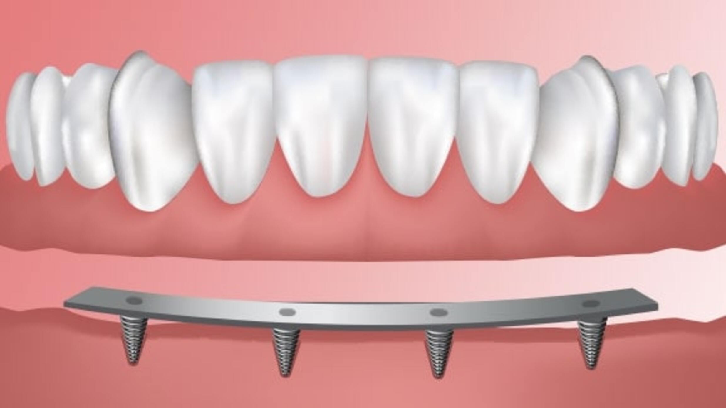 What You Need To Know About Implant Supported Dentures