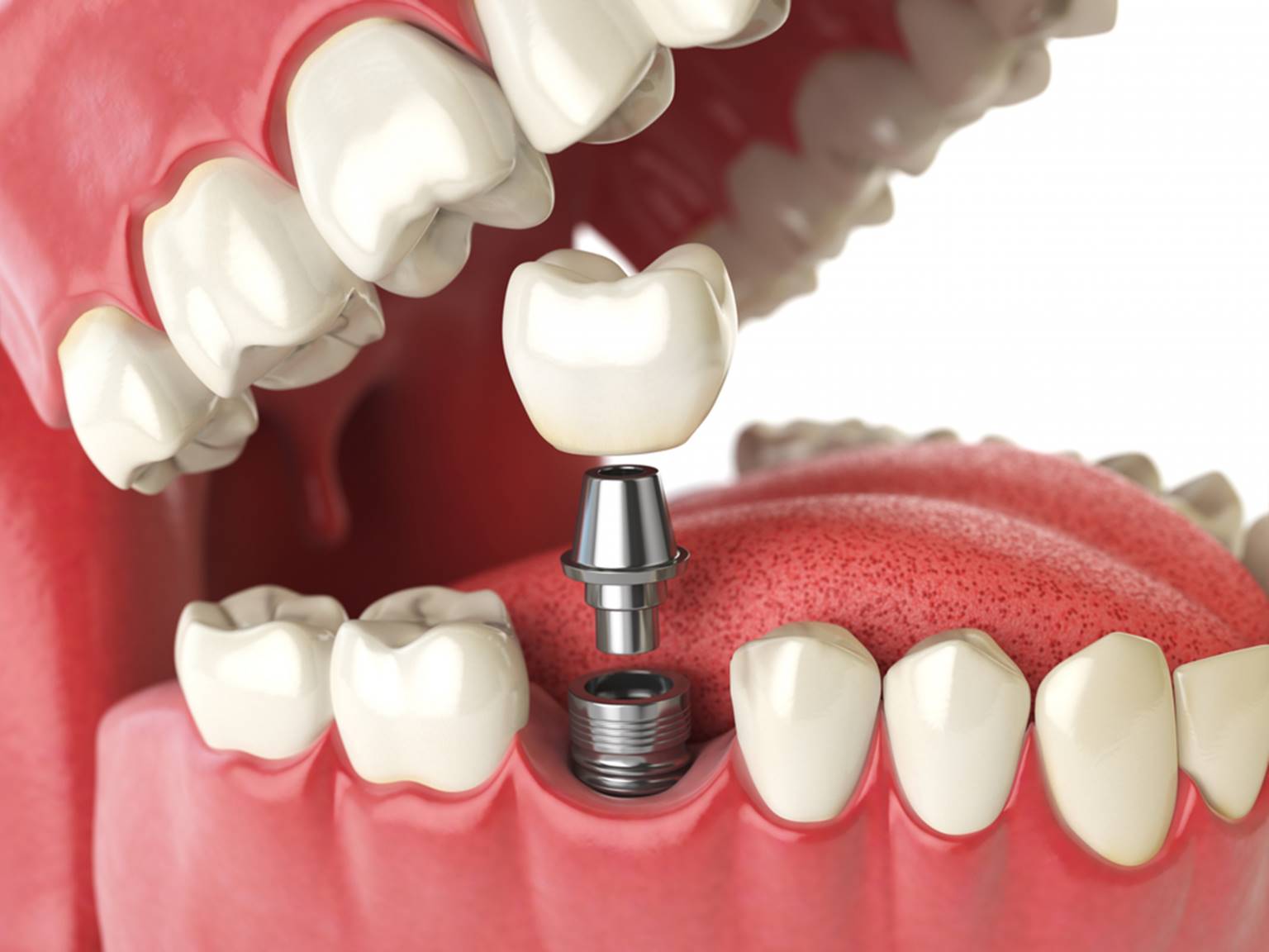 how much does a dental implant cost in canada