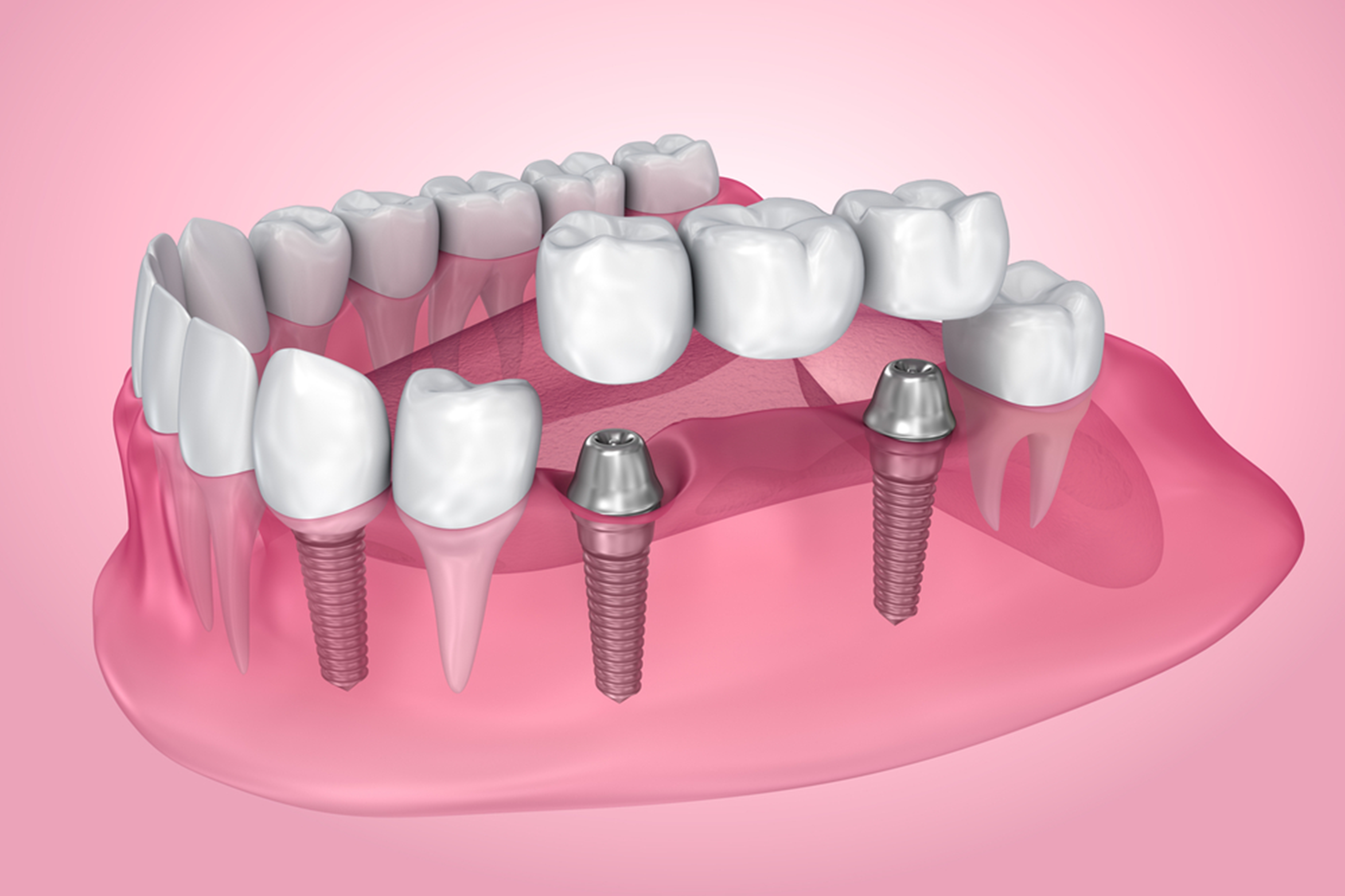 pros and cons of dental bridges