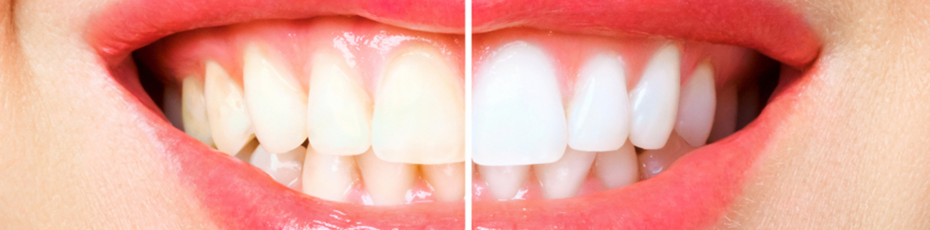 how to naturally whiten your teeth