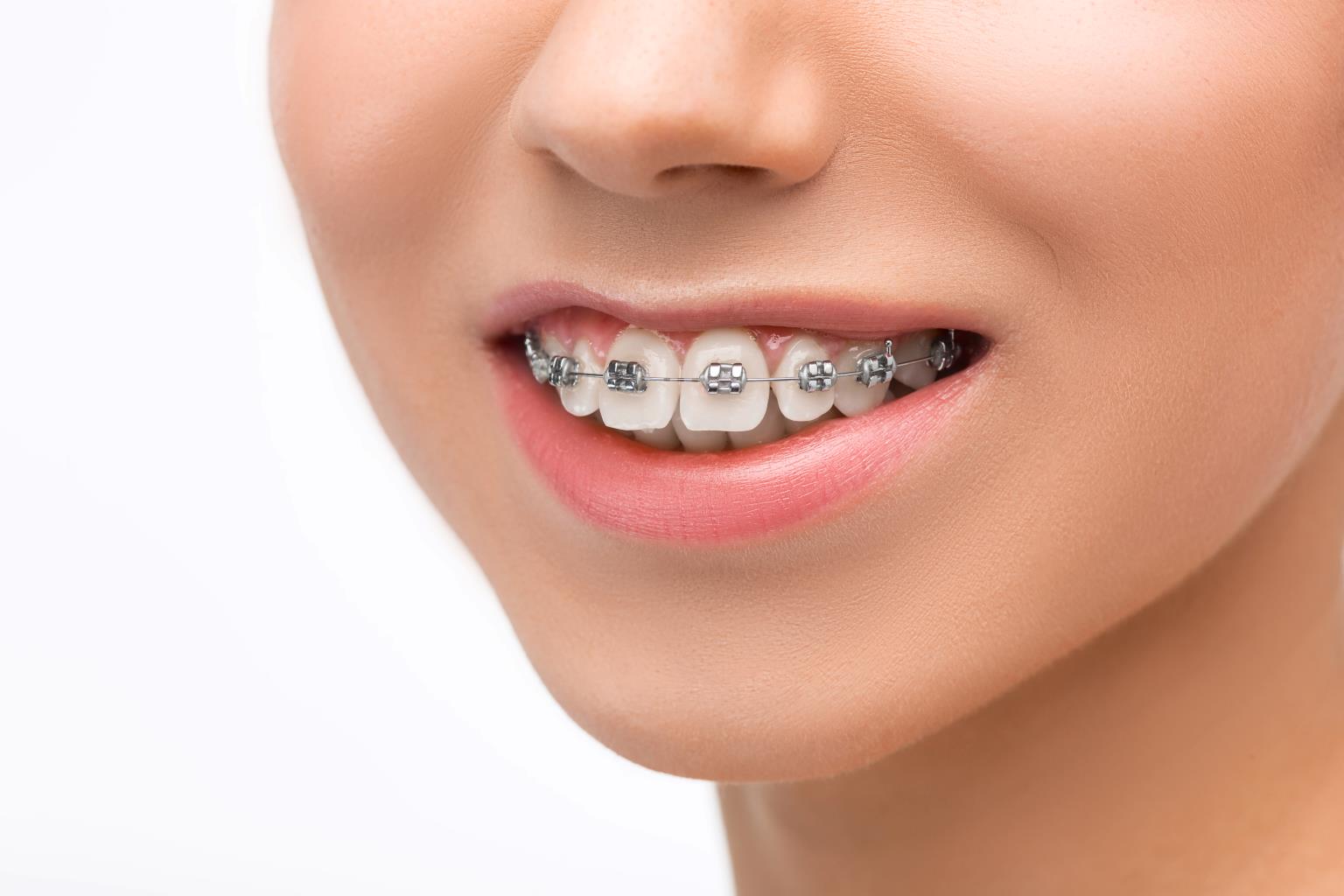 why do i still have a gap in my teeth after 3 years of braces