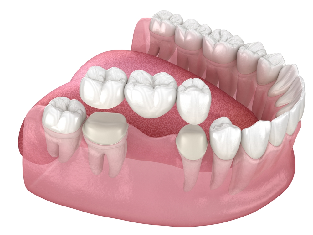 who needs a dental bridge common reasons for treatment