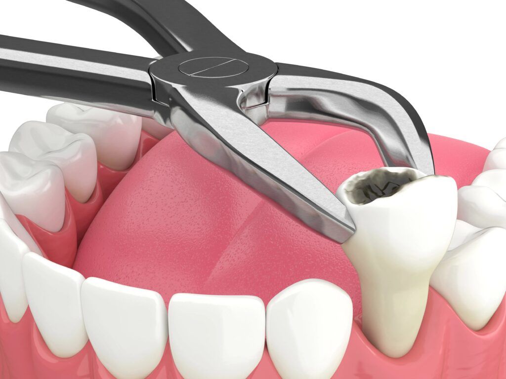 tooth extractions explained causes procedure and healing