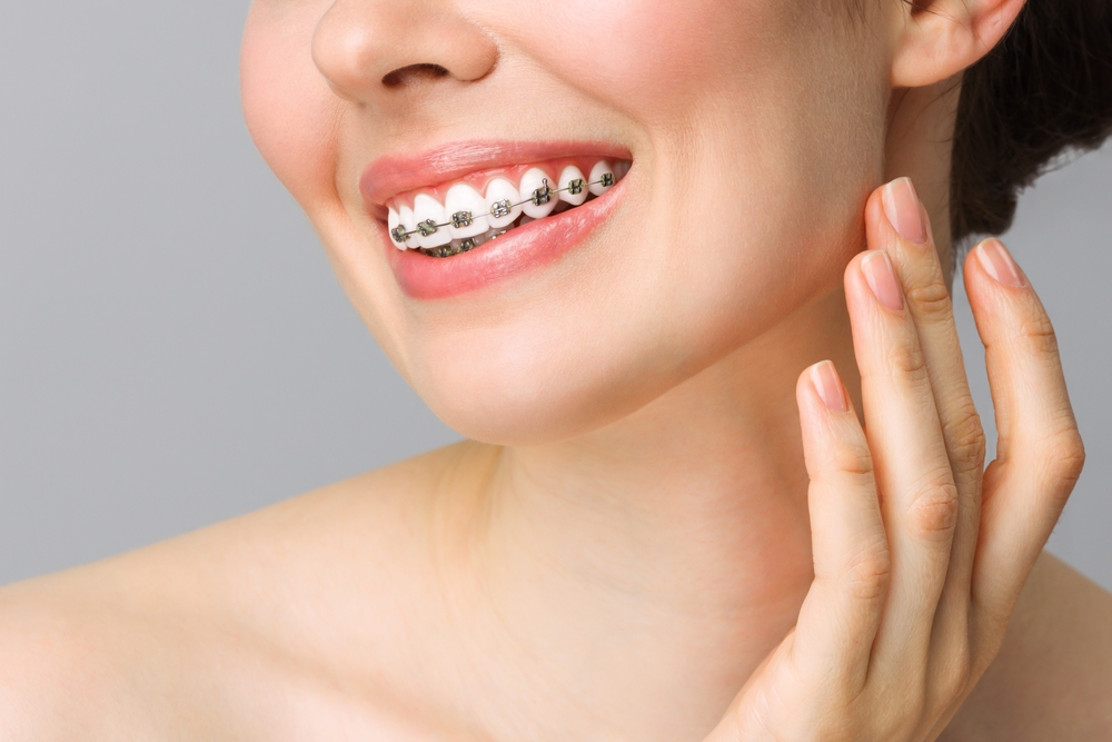 metal ceramic or clear braces choosing the best option