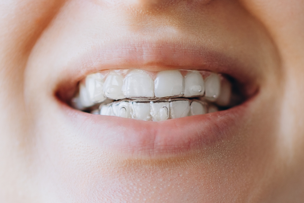 invisalign in saskatoon